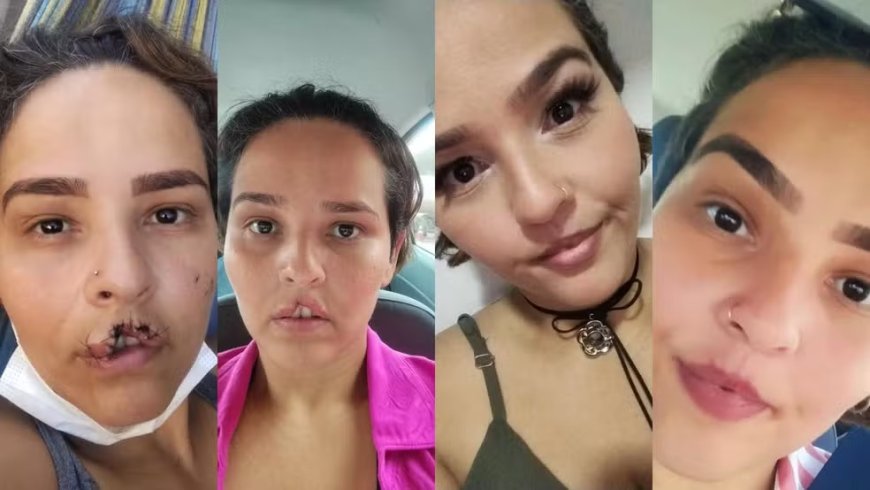 Mulher que teve lábio arrancado por chow-chow comemora 2ª cirurgia reparadora: 'trouxe minha alegria de volta'
