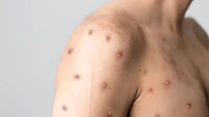 Sesau confirma quatro casos de Mpox em Porto&hellip;