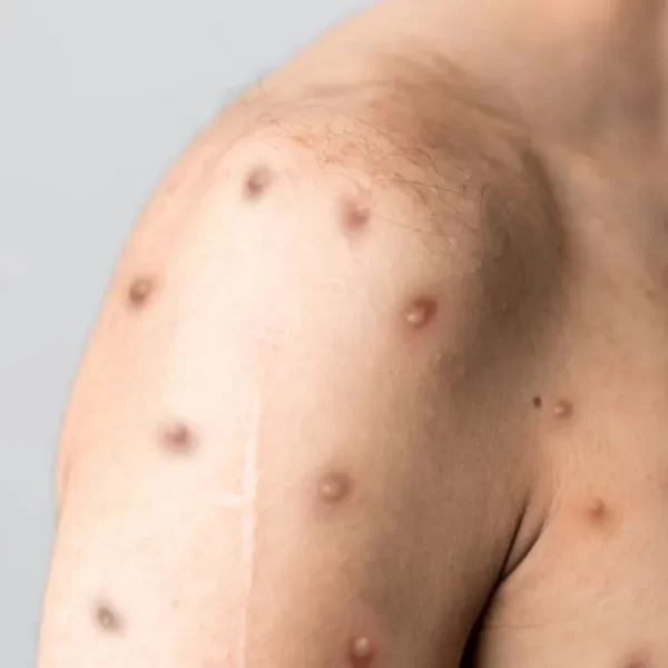 Sesau confirma quatro casos de Mpox em Porto Velho; pacientes seguem em isolamento