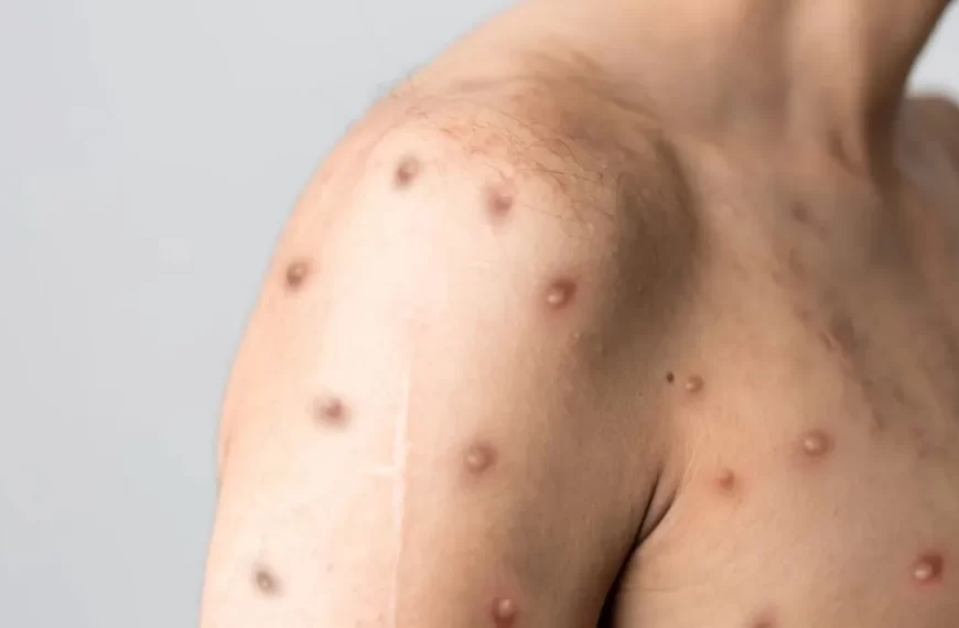 Sesau confirma quatro casos de Mpox em Porto Velho; pacientes seguem em isolamento