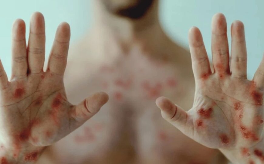 Mpox avança em Rondônia: veja quem são os 16 pacientes confirmadosLevantamento da Agevisa mostra que todos os casos foram registrados em Porto Velho; nove pacientes já estão recuperados e não houve internações.