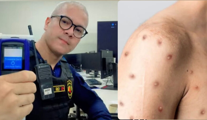 PRECAUÇÃO: Detran cancela ações da Lei Seca após servidor contaminar com o vírus Mpox