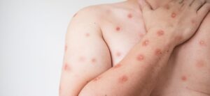 Mpox em Rondônia: quais sinais na pele observar&hellip;