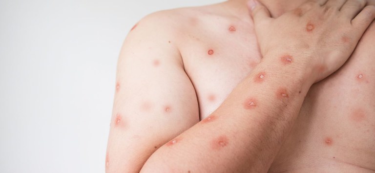 Mpox em Rondônia: quais sinais na pele observar e quando buscar atendimento