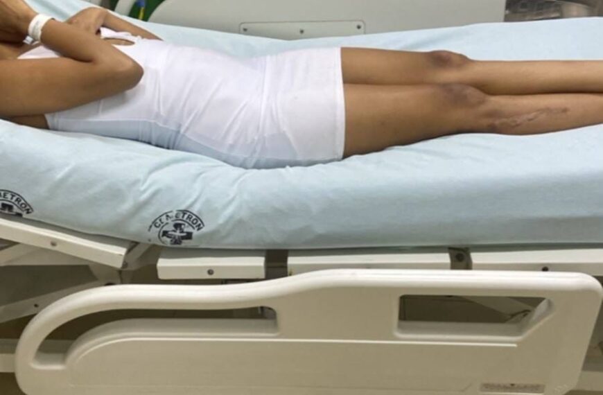 Mulher é picada por jararaca na Estrada de Ferro e caso acende alerta em Porto Velho